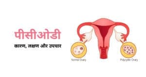 पीसीओडी का कारण, लक्षण और उपचार (PCOD in Hindi)