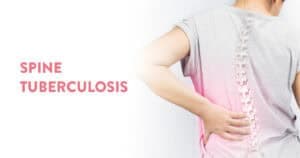 Tuberculous Spondylitis: Symptoms, Cause & Treatment