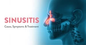 Sinusitis: Cause, Symptoms & Treatment