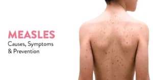 Measles: Causes, Symptoms, and Prevention