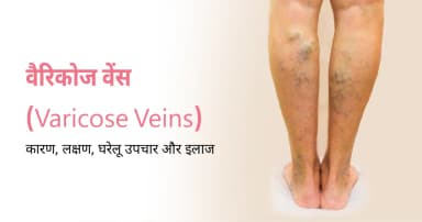 वैरिकोज वेंस (Varicose Veins): कारण, लक्षण, घरेलू उपचार और इलाज