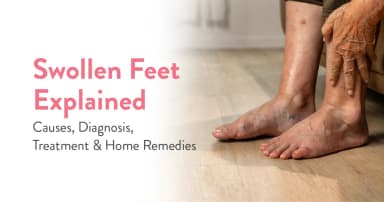 Swelling Feet: Causes, Diagnosis and Home Remedies