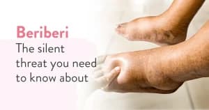 Beriberi (Thiamine Deficiency): Types, Causes, Symptoms & Treatments