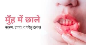 मुँह में छाले: कारण, उपाय, व घरेलु इलाज़