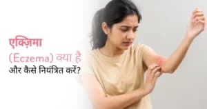 एक्जिमा क्या होता है? इसके प्रकार, लक्षण और उपाय