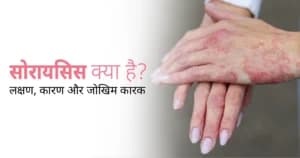 सोरायसिस क्या है? लक्षण, कारण, प्रकार और जोखिम कारक की पूरी जानकारी