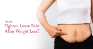 How to Tighten Loose Skin After Weight Loss?