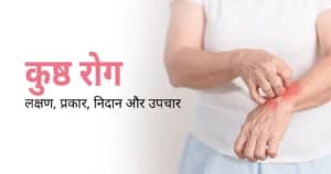 कुष्ठ रोग – कारण, लक्षण, प्रकार और उपचार