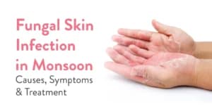 Fungal Skin Infection in Monsoon: Causes, Symptoms & Treatment