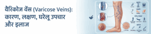 वैरिकोज वेंस (Varicose Veins): कारण, लक्षण, घरेलू उपचार और इलाज