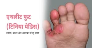 एथलीट फुट (टिनिया पेडिस): कारण, लक्षण, घरेलू उपाय और इलाज