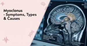 Myoclonus: Types, Causes and Treatment