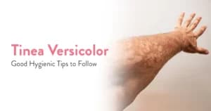 Tinea Versicolor: Symptoms, Causes, and Treatment