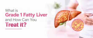 What is Grade 1 Fatty Liver and How Can You Treat It?