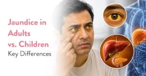 Jaundice in Adults vs Children: Causes, Symptoms & Treatment