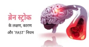 ब्रेन स्ट्रोक के लक्षण, कारण और ‘FAST’ नियम