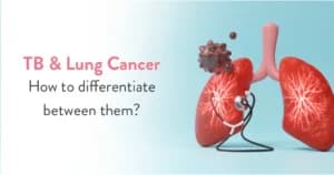 TB vs Lung Cancer: Symptoms, Diagnosis and Key Differences