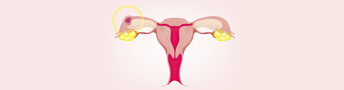 Tubal Ectopic Pregnancy