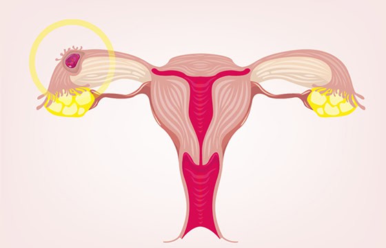 Tubal Ectopic Pregnancy