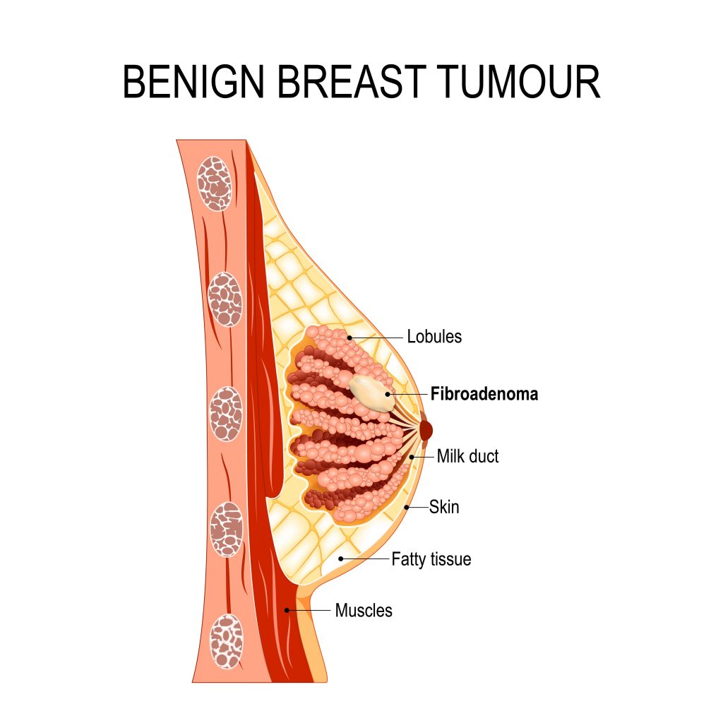 Benign Breast tumor disease