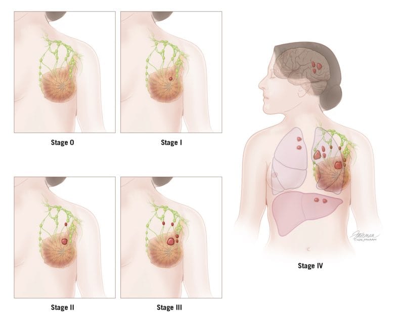 How does tumor size relate to breast cancer stages