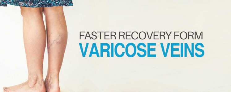 varicose veins treatment, varicose veins, swollen veins