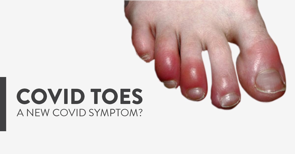 “covid Toes” The New Covid 19 Mystery Symptom Explained Ck Birla Hospital