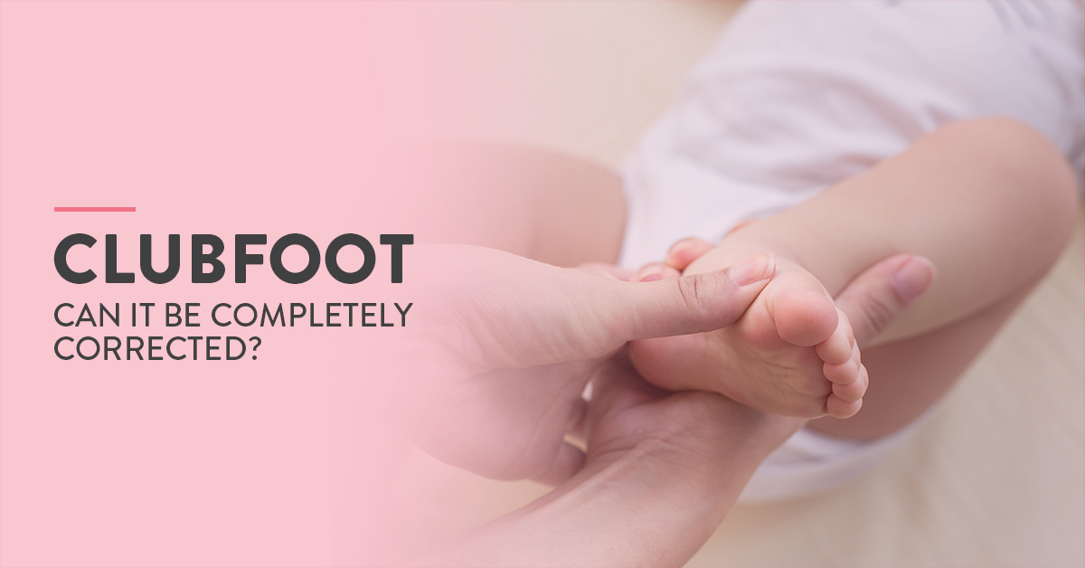 Clubfoot, clubfoot treatment, clubfoot diagnosis