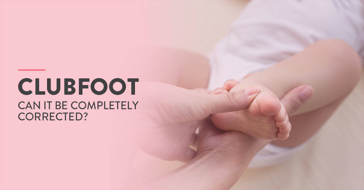 Clubfoot, clubfoot treatment, clubfoot diagnosis