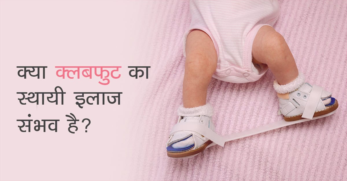 Clubfoot in Hindi, Clubfoot meaning in Hindi, Clubfoot treatment in Hindi