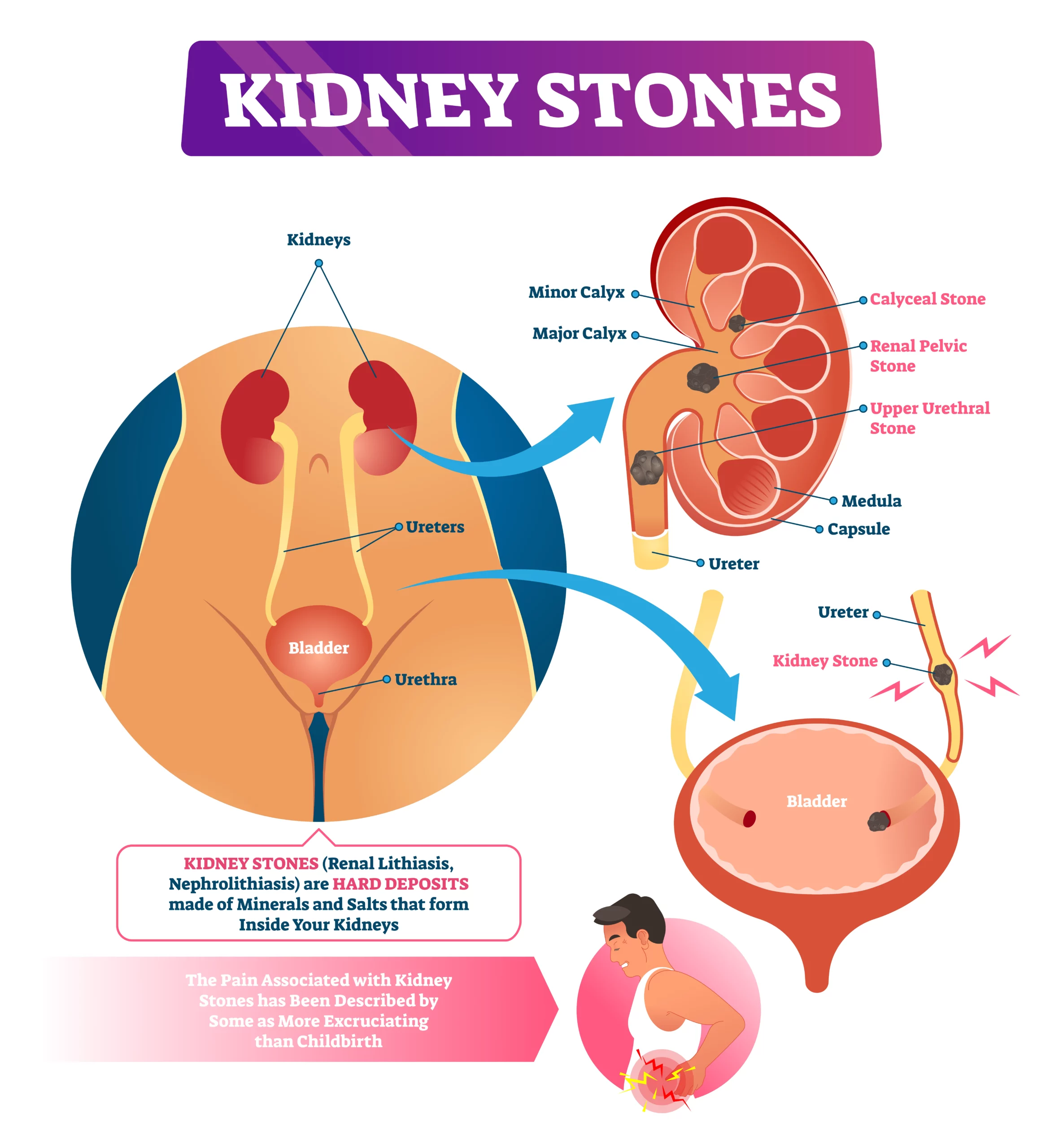 Kidney Stones, Kidney Stone Symptoms, Nephrolithiasis