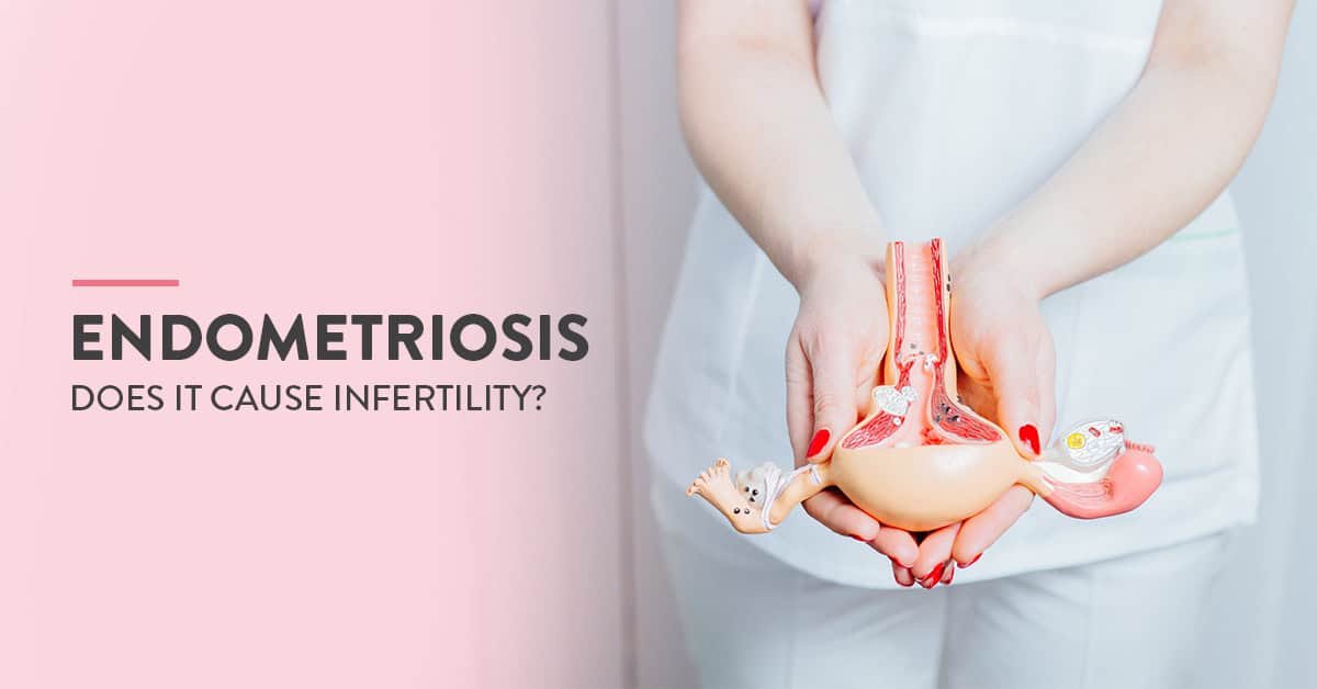 Endometriosis, Endometriosis Symptoms, What is endometriosis, Endometriosis causes, Endometriosis pain, Endometriosis Diagnosis, Endometriosis Ovarian cyst, Endometriosis and infertility, endometriosis and infertility treatment