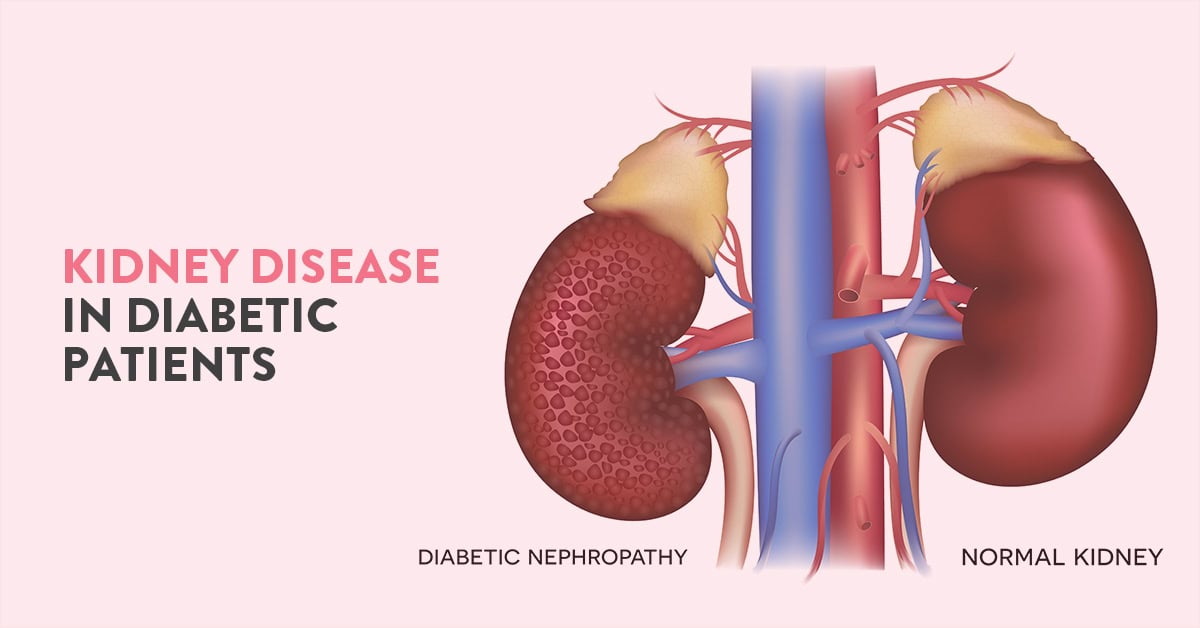 diabetic Kidney Disease, diabetes and kidney disease, diabetic nephropathy, diabetic Kidney Disease symptoms, diabetes and kidney disease stages, Can kidney disease cause diabetes, how does diabetes cause kidney disease, diabetes and kidney disease treatment, Diabetes and Kidney disease diet, Foods to avoid with Kidney disease and Diabetes Kidney diasease, complications of Diabetes, how to reverse kidney damage from diabetes, how long does it take for diabetes to cause kidney damage, diabetic Kidney Disease diagnosis