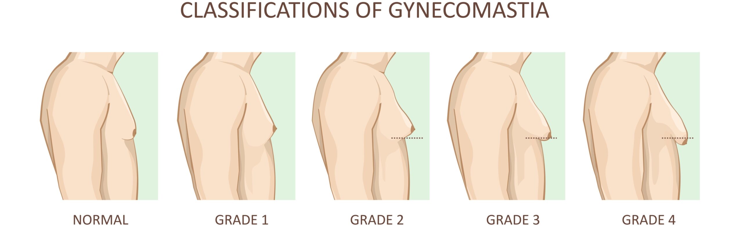 Swollen male breast tissue condition - gynecomastia