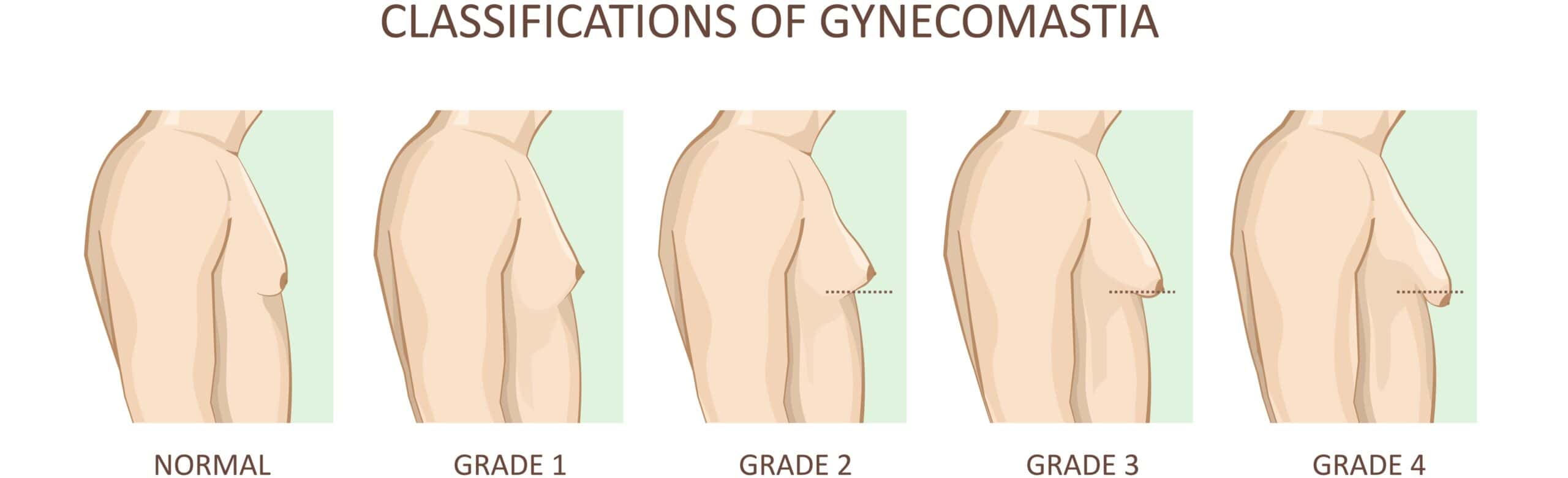 Scar on left inner thigh from operation to remove a high grade