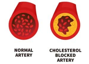 Image showing cholesterol blocked arteries vs normal artery 