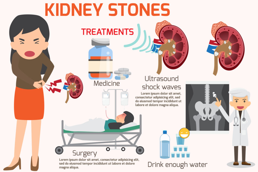 Image showing kidney stone treatments