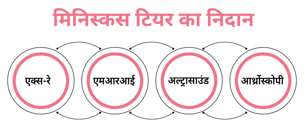 Diagnosis of Meniscus tear in hindi