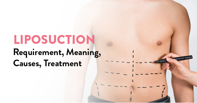 What is liposuction Thumbnail Link