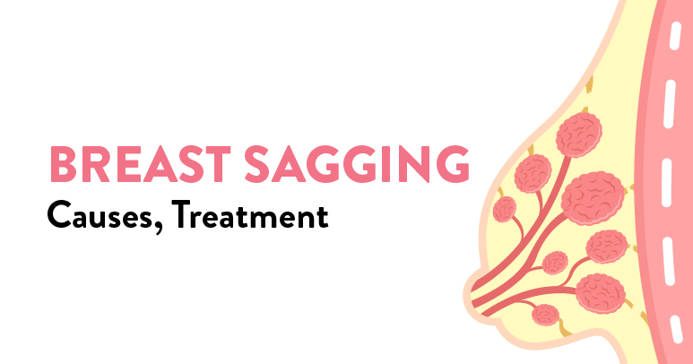 breast Sagging causes, treatment