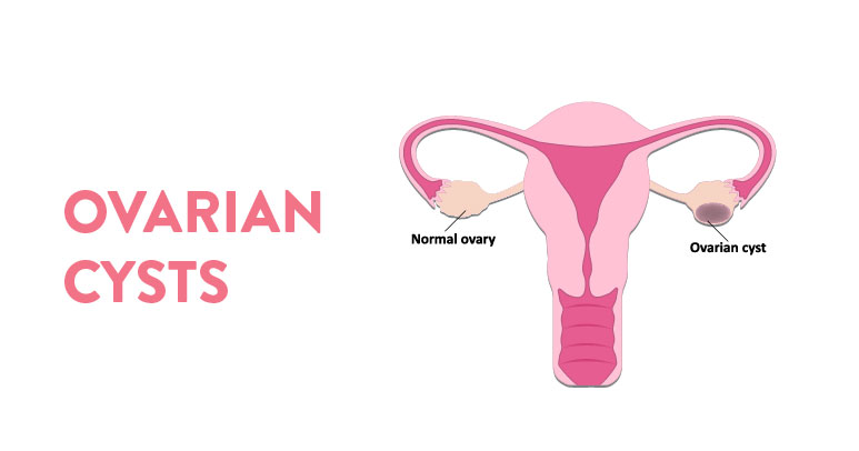 Ovarian cyst Explained