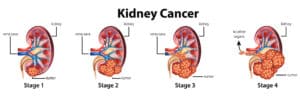 Kidney cancer stages 