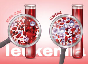 Overview of leukaemia