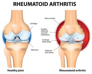Rheumatoid arthritis causes 