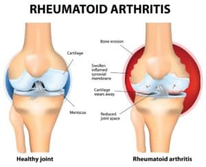 Rheumatoid arthritis causes 