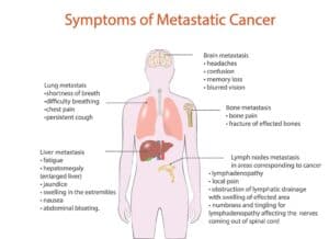 Sarcoma symptoms 