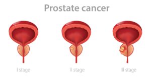 Stages of prostate cancer 