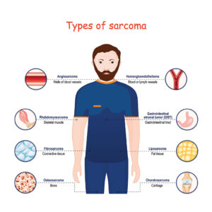 Types of sarcoma
