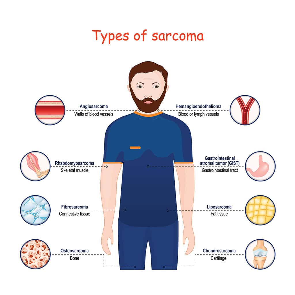 All You Need To Know About Sarcoma Ck Birla Hospital