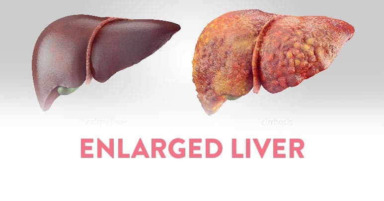 All About Enlarged Liver Thumbnail Link